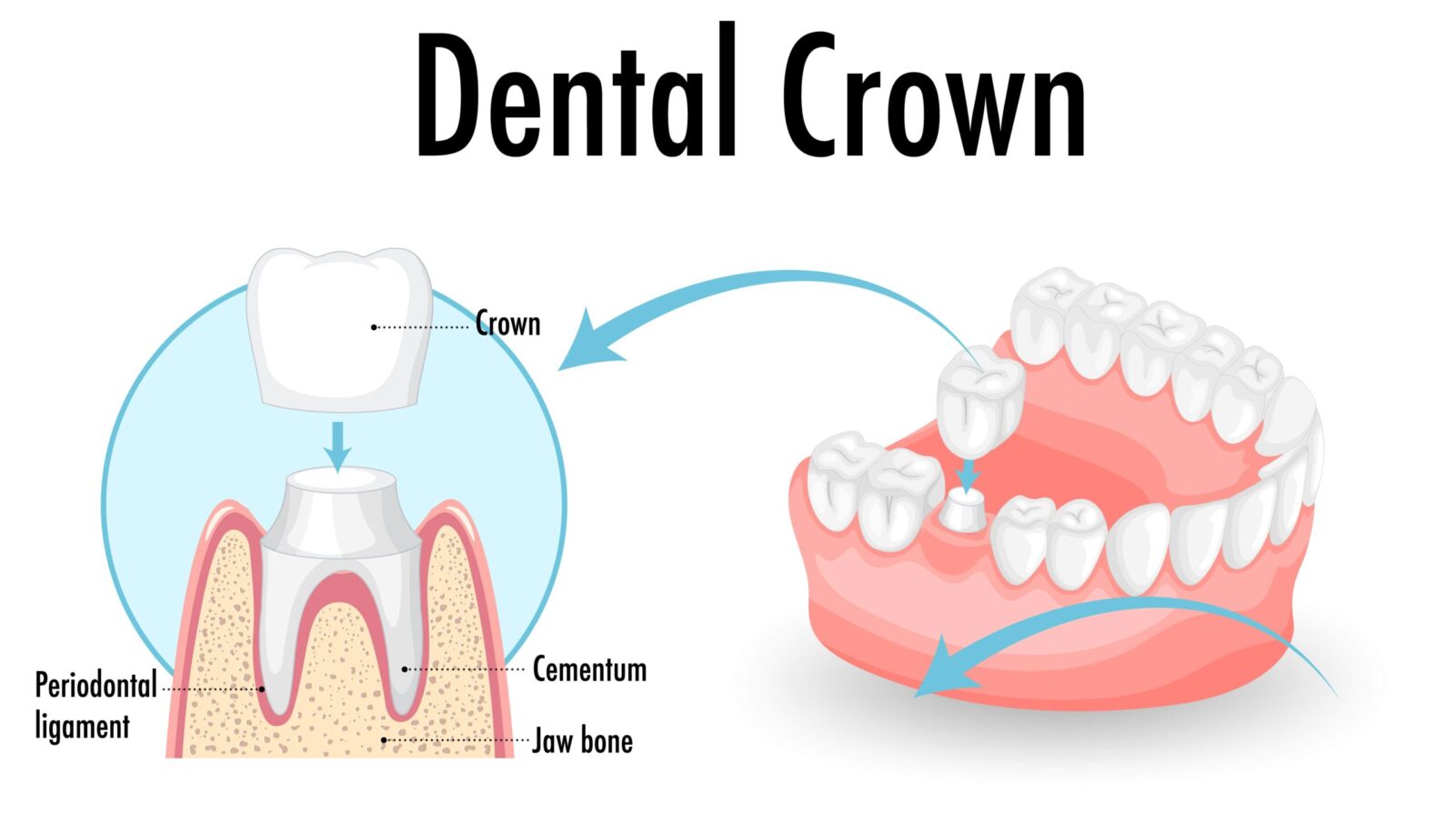 Dental Crown is the best procedure for restoring your broken tooth