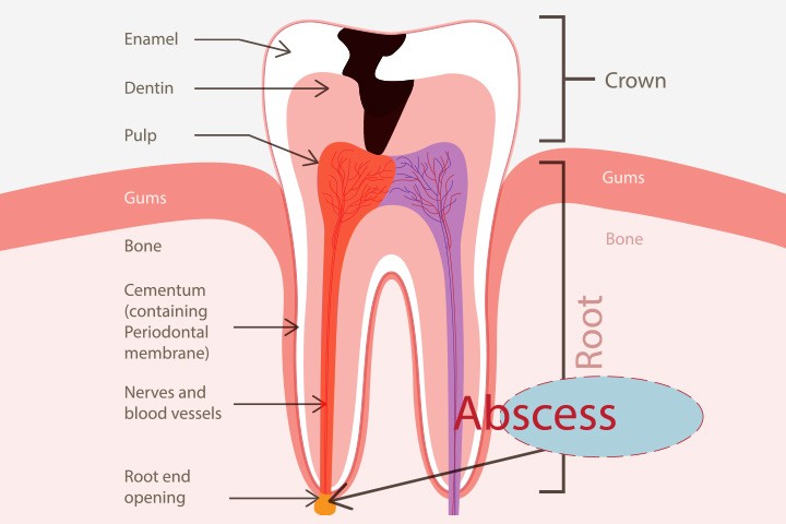 What You Need to Know about Tooth Abscess