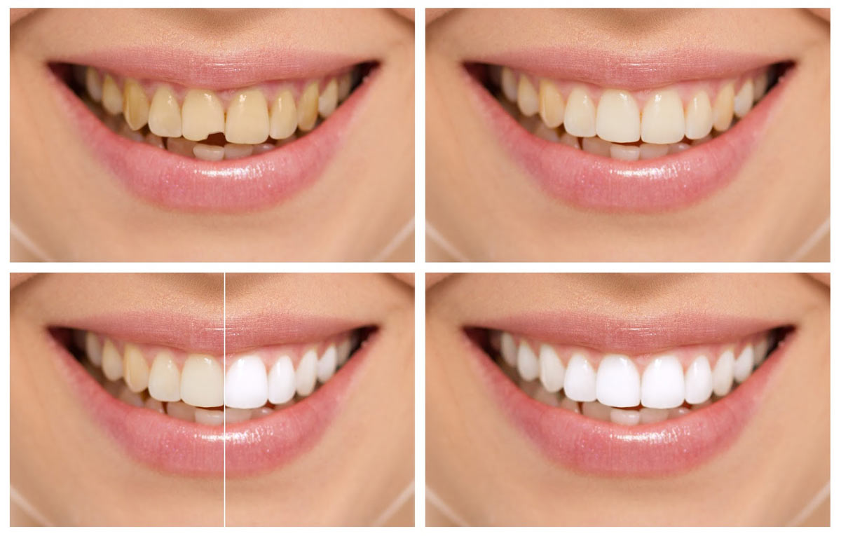What is the Purpose of Dental Bonding?
