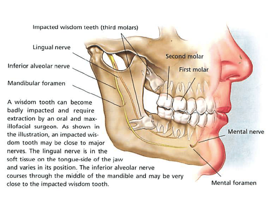 Tooth Extraction procedure and post instruction