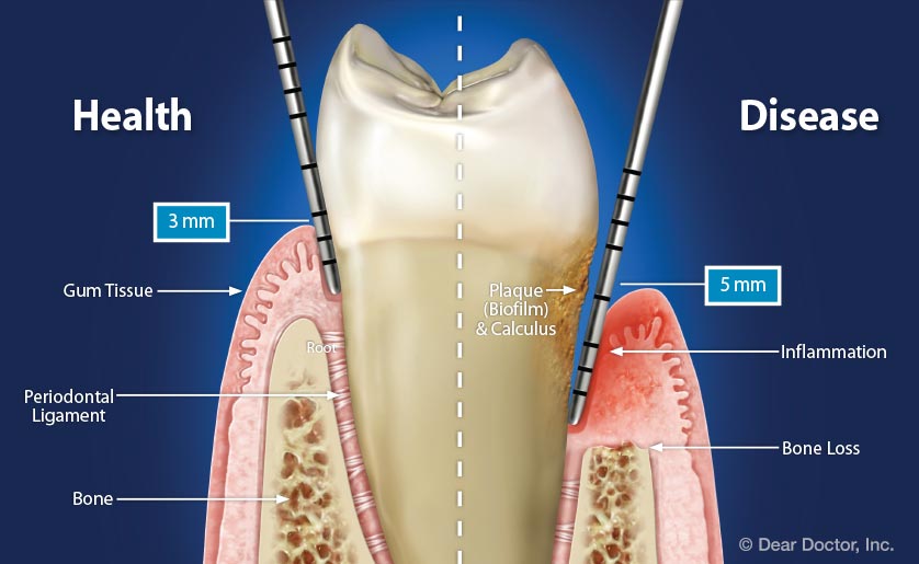 Periodontal Disease