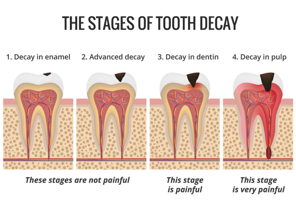 Tooth cavities
