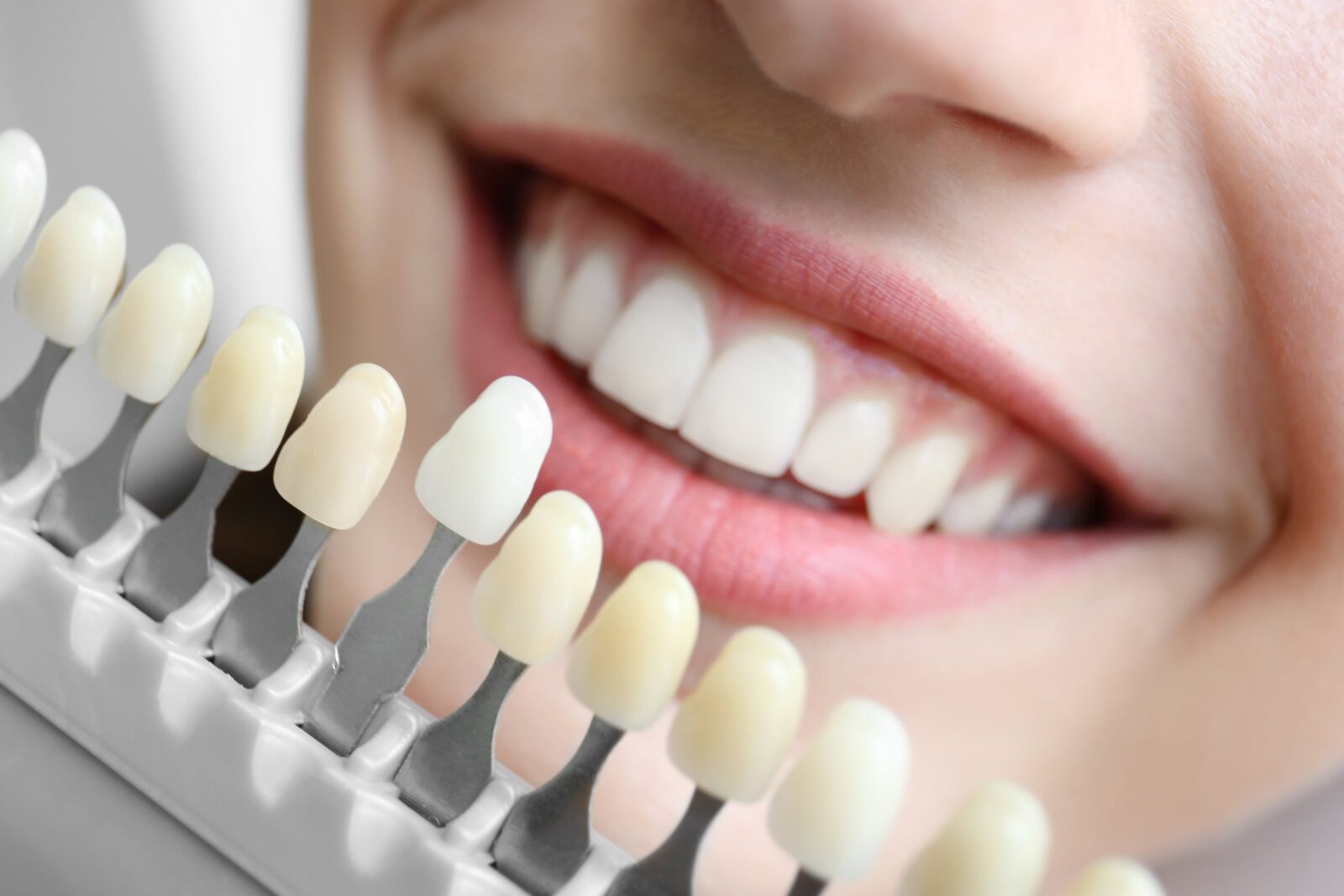 A close-up of a bright smile with white teeth and a teeth shade guide being used to compare shades, showcasing professional teeth whitening services by a dentist in Montebello.