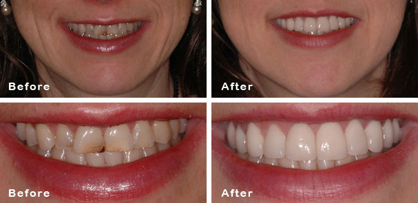 Dental Crown Restoration