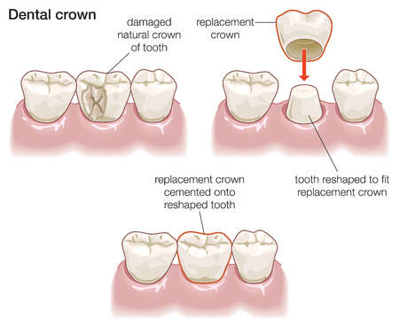 What are Dental Crowns Used for?