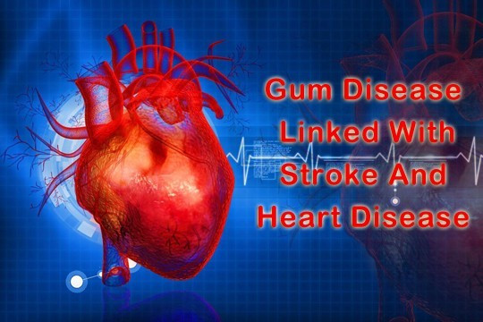 Link between Gum disease and Heart disease