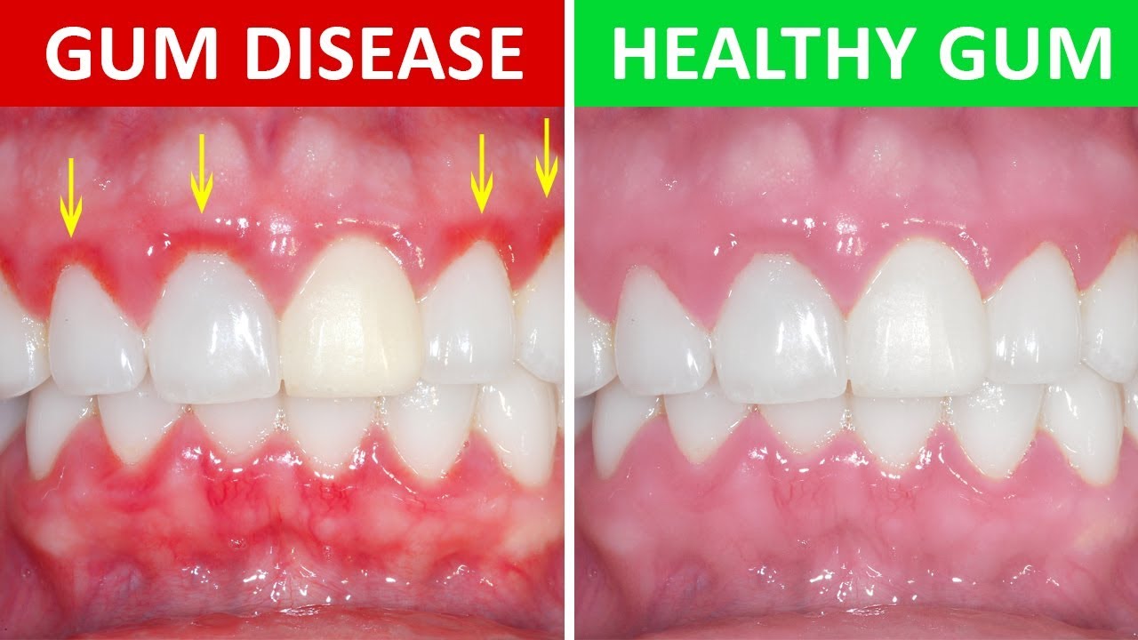 Gingivitis: Causes, symptoms, and treatment At Vistasol Dental