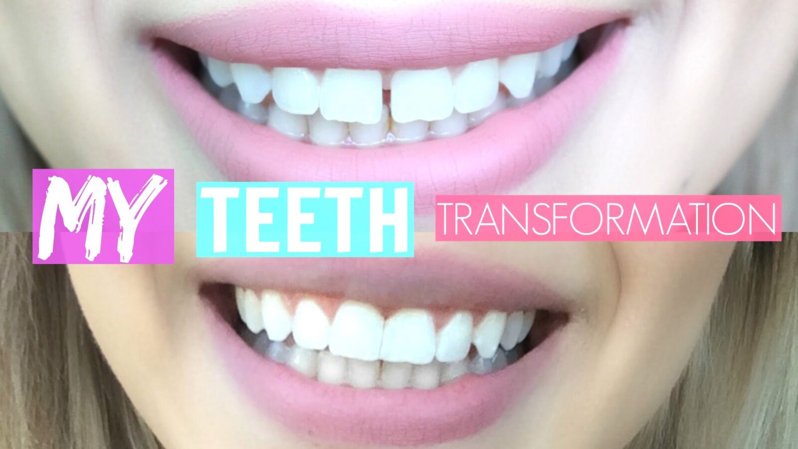 Purpose of Dental Bonding