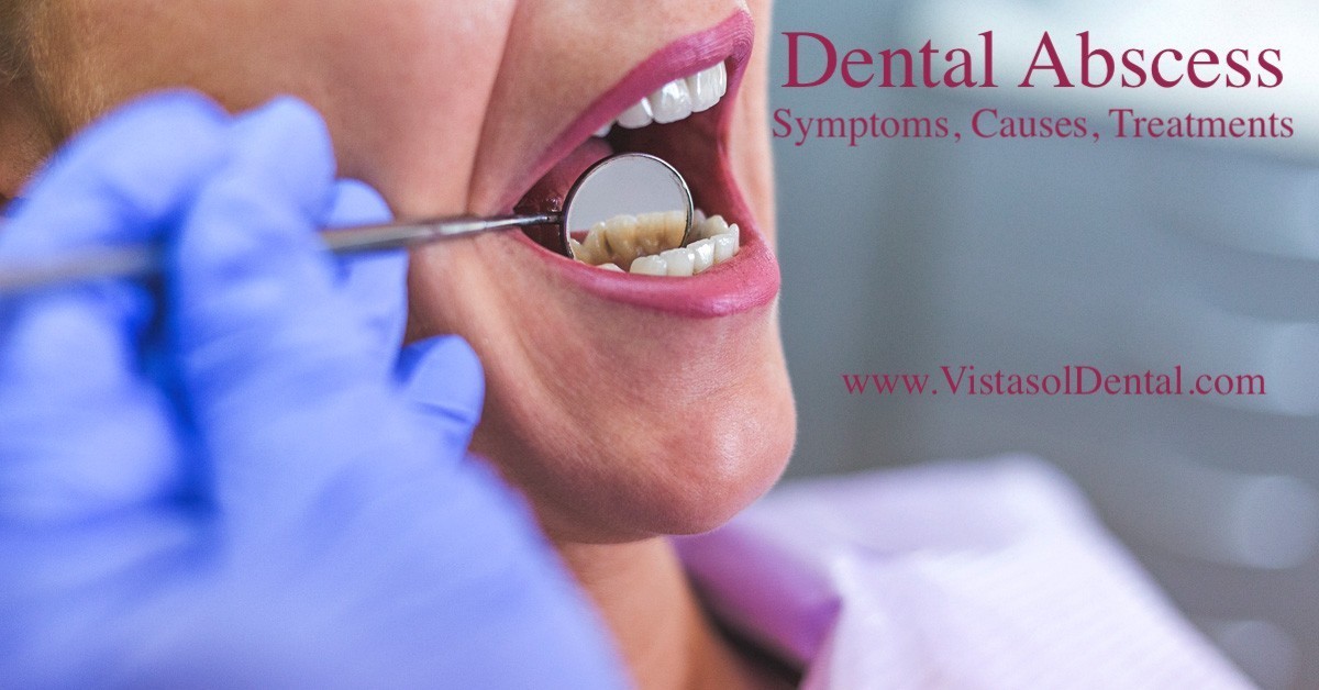 What’s to know about dental abscesses?