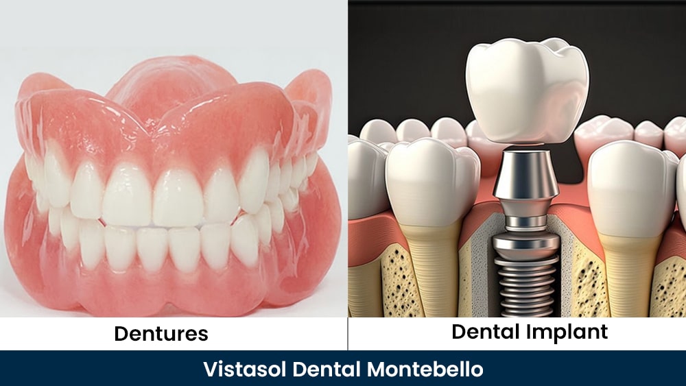 Dental Implants vs.Dentures: Which Option is Right for You?