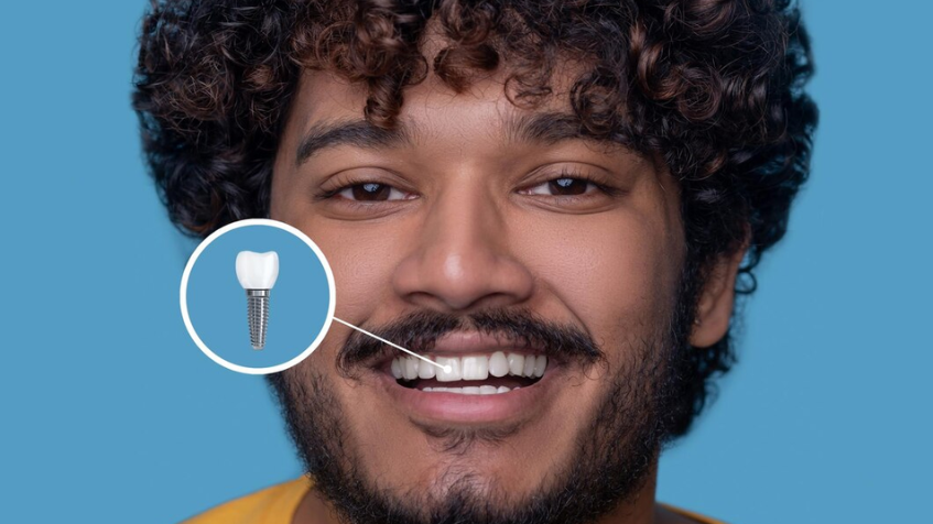Dental Implants: Benefits, Potential Risks,and Recovery Tips