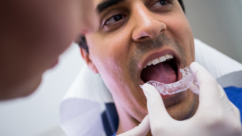 Why a family dentist recommends custom mouthguards